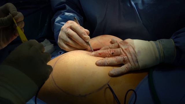 BUTT IMPLANTS IN 4K (Buttock Enhancement Surgery)