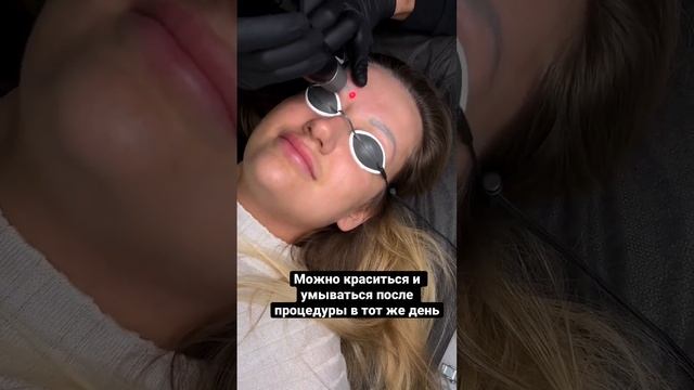 Процедура удаления татуажа бровей лазером #лазерноеудалениетатуажа #лазерноеудалениетату смотреть онлайн