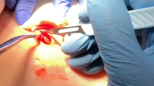 КЕРАТОМА - доброкачественно, но лучше УДАЛИТЬ! смотреть онлайн