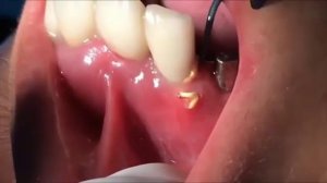 Фууу! Гной из десны.