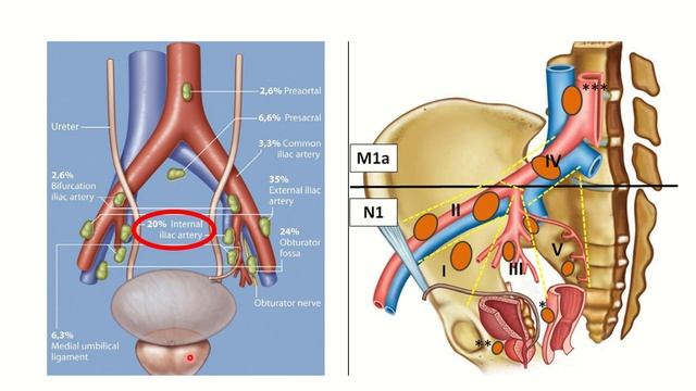 Lymphatic drainage of prostate MRCS question solve (CRACK MRCS) смотреть онлайн