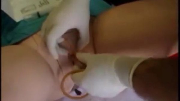 Катетеризация мочевого пузыря женщины и мужчины катетером Фолея с озвучиванием