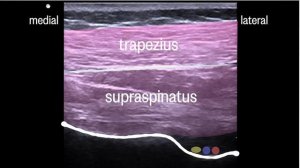 Блокада надлопаточного и подмышечного нервов