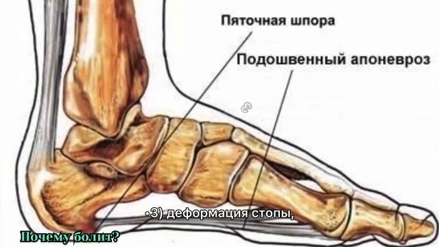 Трещины на пятках. Зная 11 причин, не предаётся лечить. смотреть онлайн