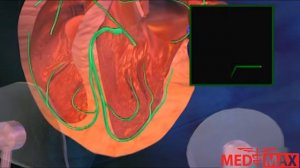 Брадикардия сердца. Как происходит?