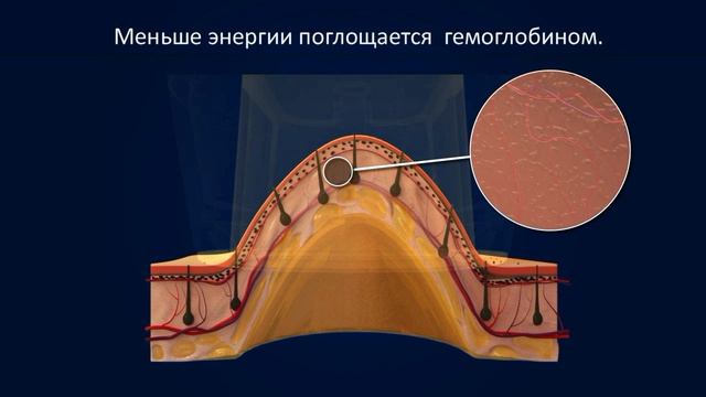 Лазерная эпиляция Light Sheer DUET смотреть онлайн