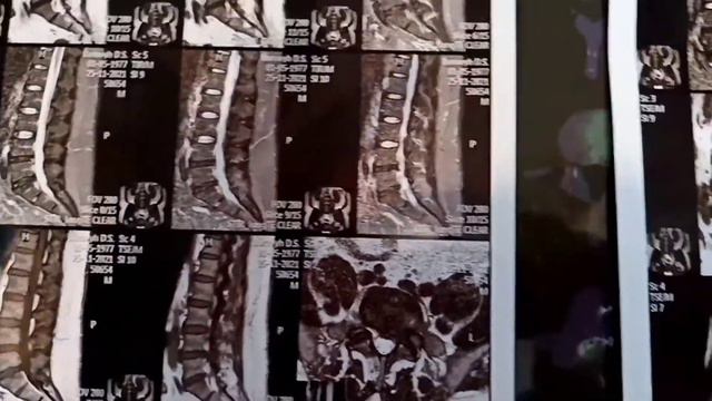 если грыжу позвоночника не лечить, и если лечить грыжу межпозвонкового диска, в чём разница? смотреть онлайн