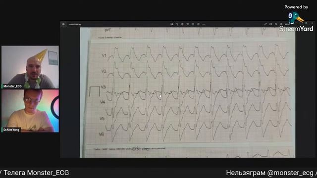 Разбор ЭКГ №11 (День Рождения!) смотреть онлайн