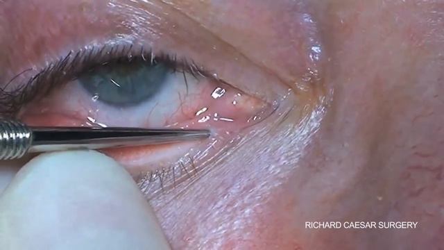 3snippunctoplasty смотреть онлайн