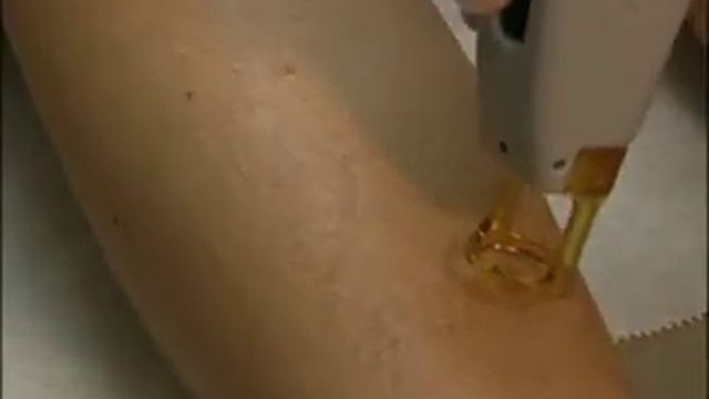 Лазерная эпиляция ног смотреть онлайн