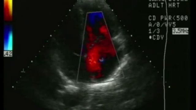 Дефект межпредсердной перегородки, эхокардиография после 45 лет смотреть онлайн