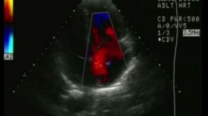 Дефект межпредсердной перегородки, эхокардиография после 45 лет