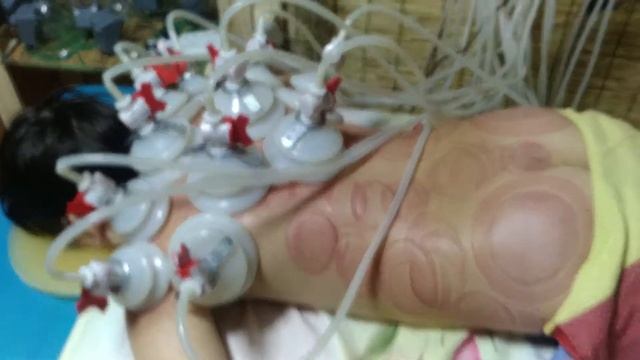 Вакуумный массаж - коррекция осанки (сутулость) 11 летнего ребенка смотреть онлайн