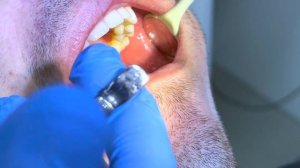 Техника проведения мандибулярной анестезии , проводниковая анестезия #стоматология #кариес #зуб