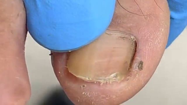 Lots of dirt hiding under the toenails【Xue Yidao Pedicure】 смотреть онлайн