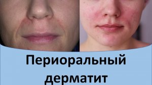 Периоральный дерматит.