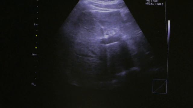 Echinococcosis - Ехинококоза смотреть онлайн
