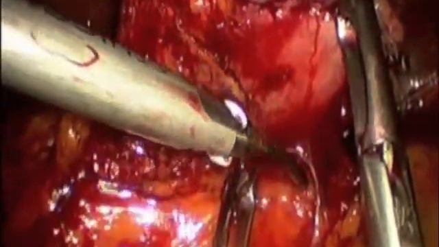 Laparoscopic Distal Gastrectomy With Billroth I Reconstruction смотреть онлайн