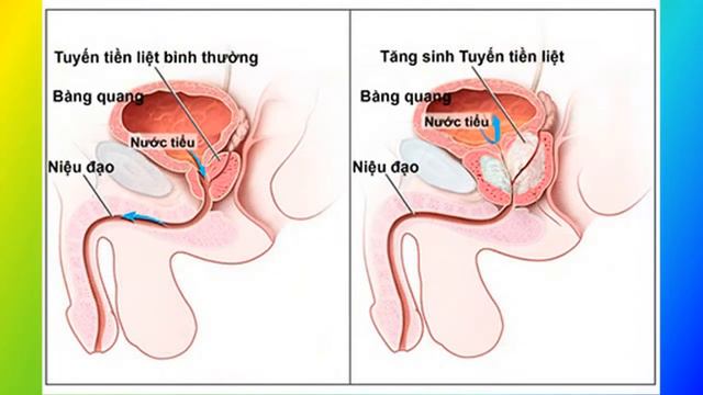 Tuyến tiền liệt phì đại смотреть онлайн