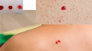 Tanadagi qizil toshmalar nimaning belgisi