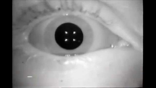 Виды нистагма