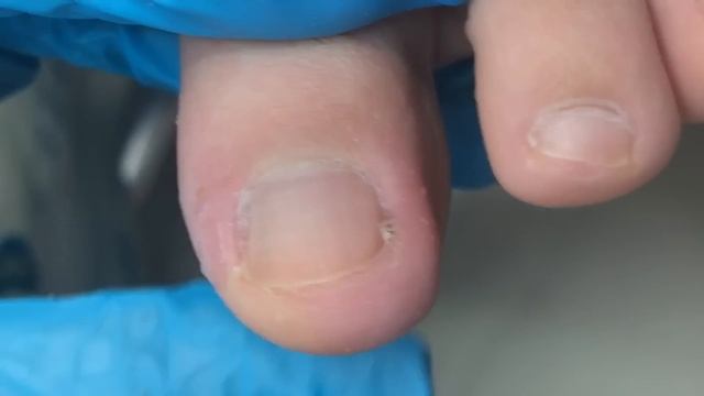 Ingrown nails make toes swell and peel!【Crazy pedicure room】 смотреть онлайн