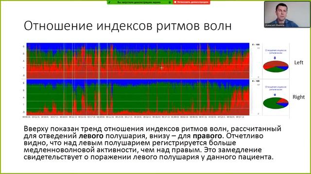 Применение трендов ЭЭГ и ПСГ для анализа длительных обследований смотреть онлайн