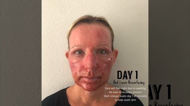 CO2 Laser Resurfacing ~ CO2RE смотреть онлайн