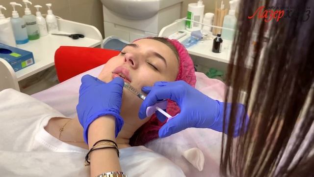 Контурная пластика губ смотреть онлайн