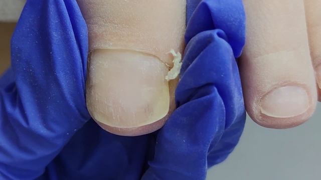 ОГРОМНАЯ ПОДНОГТЕВАЯ МОЗОЛЬ В МАКРО ? Как убрать подногтевую мозоль подробно. Почему болят ногти? смотреть онлайн