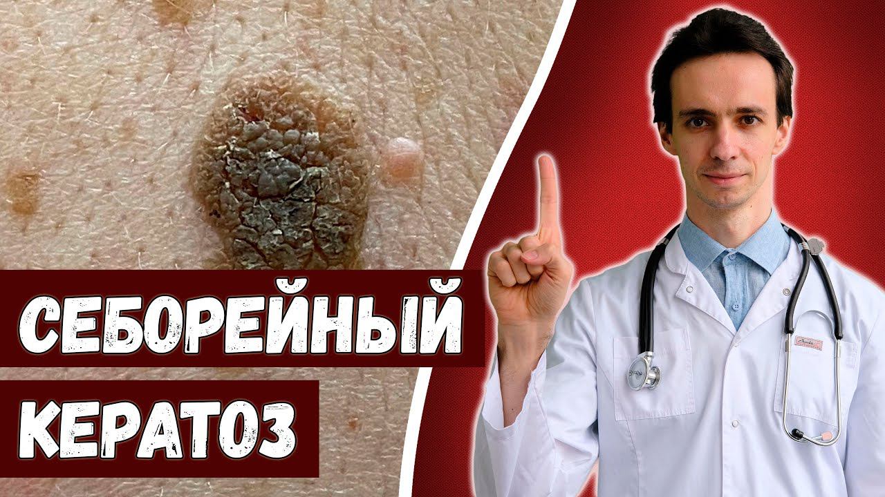 Себорейный кератоз  Что это и как лечить?