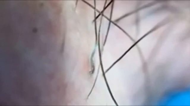 Вросшие волосы / Удаление волос / Какие способы удаления волос есть? смотреть онлайн