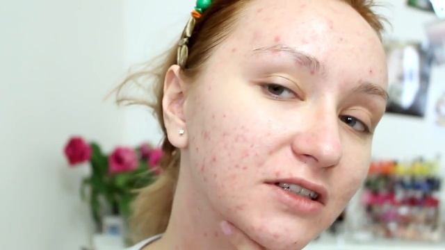 Прием ретиноидов при акне. смотреть онлайн