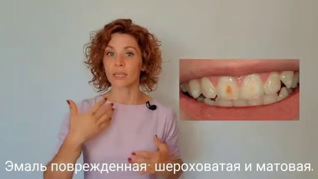 как определить кариес в домашних условиях? смотреть онлайн