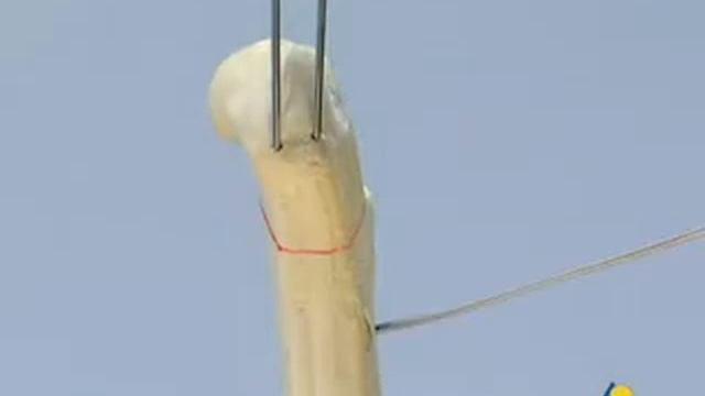 Перелом большого вертела смотреть онлайн