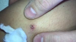 КАК Выдавить ПРЫЩ!!!!!!!! )