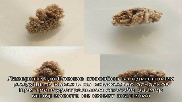 Как дробят камни в мочеточнике смотреть онлайн
