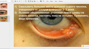 Народные средства от ячменя, советы врачей.