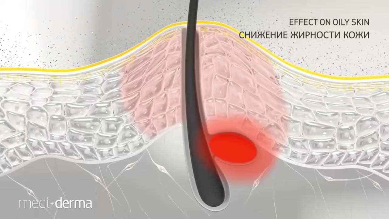 Феруловый пилинг против воспалений смотреть онлайн