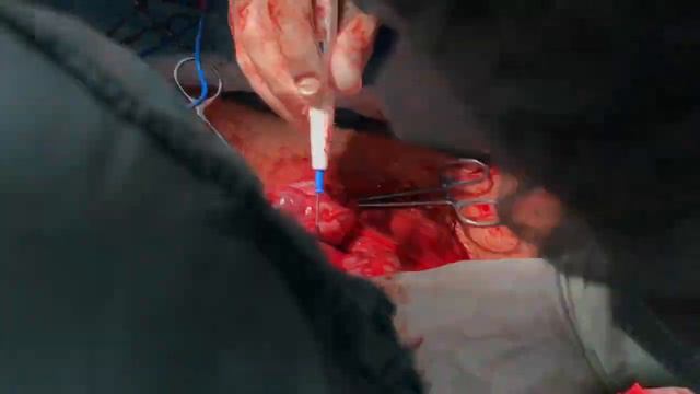 Врастание плаценты.Placenta percreta. смотреть онлайн