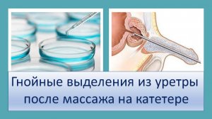 Гнойные выделения из уретры после массажа на катетере