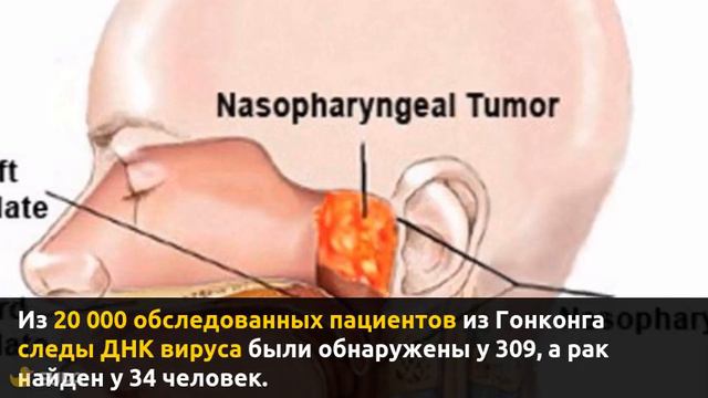 О скрининге на рак носоглотки смотреть онлайн
