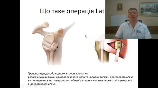 Звичний звих плеча смотреть онлайн