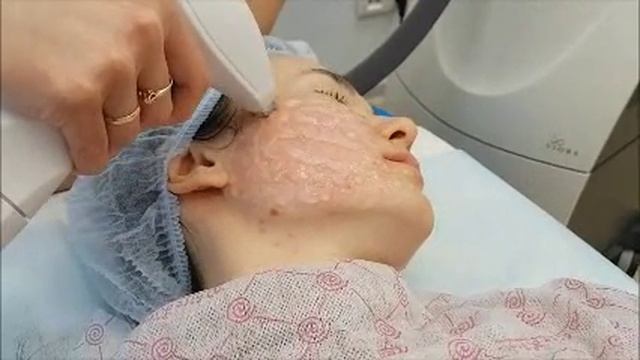 Биполярный радиоволновой лифтинг ReAction c вакуумом смотреть онлайн