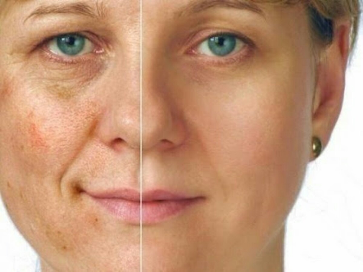 ВОЗРАСТНЫЕ ИЗМЕНЕНИЯ И ПИГМЕНТНЫЕ ПЯТНА