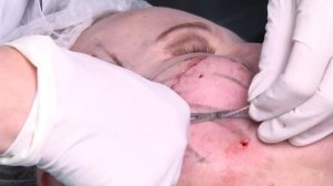 Армирование лица бразильскими нитями в Институте Косметологии и Дерматологии