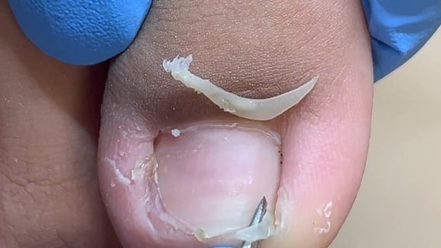 Pedicure For Students: Puffy Toes, Clean Up Ingrown Nails【Xue Yidao】