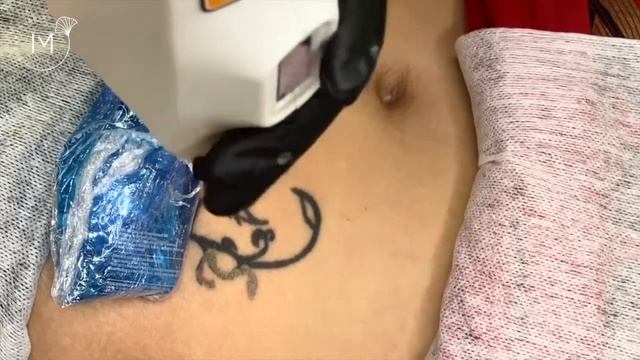 УДАЛЕНИЕ ТАТУИРОВКИ ЛАЗЕРОМ смотреть онлайн