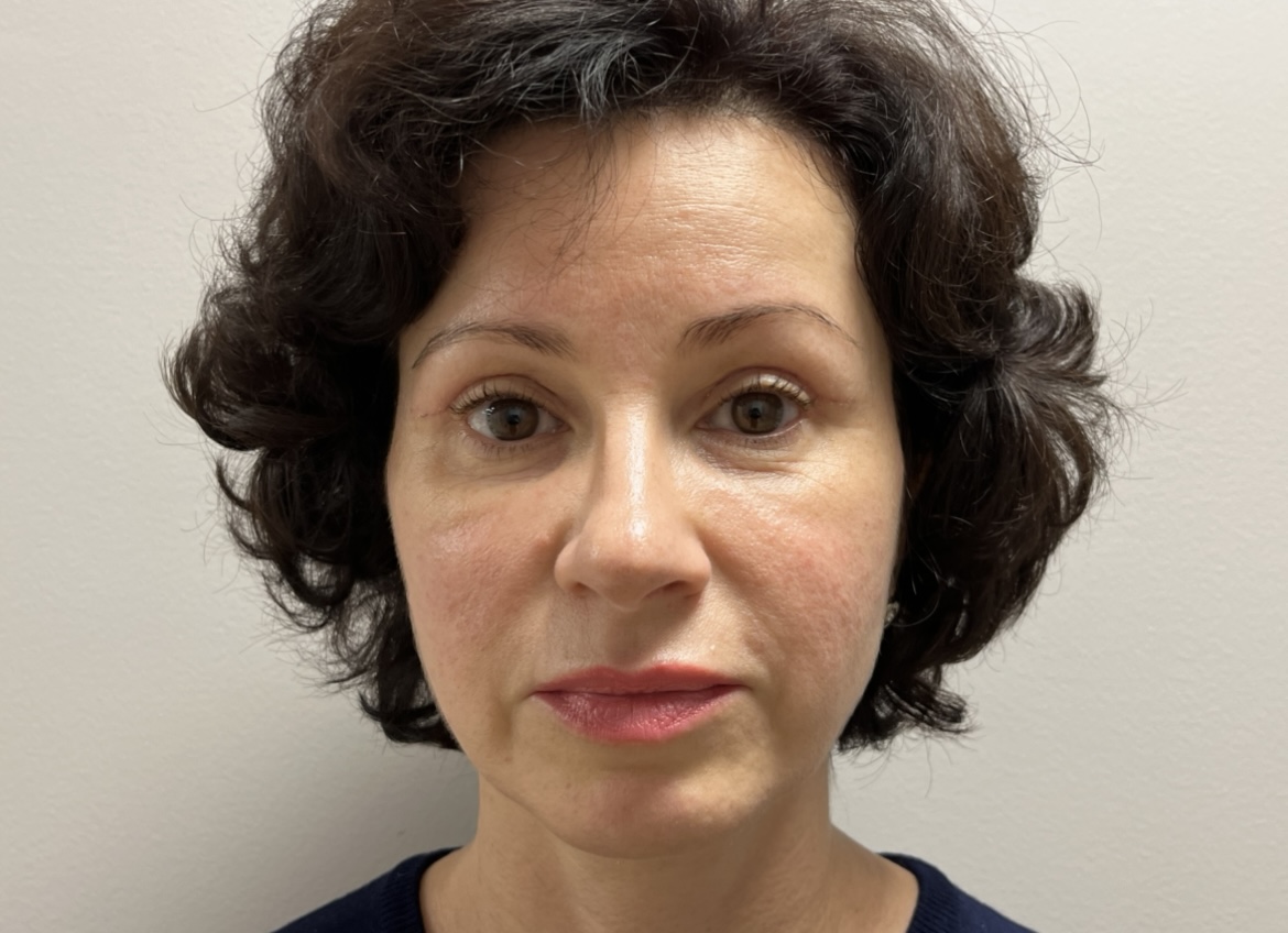 Блефаропластика верхних век. Отзыв Ольги.