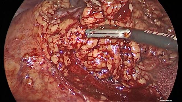 Кобзев: резекция почки